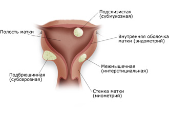 Фибромиома